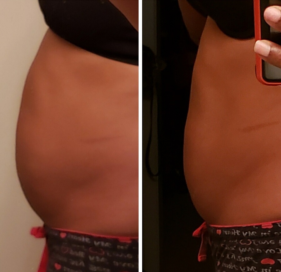 Uterine Fibroid Embolization before and after