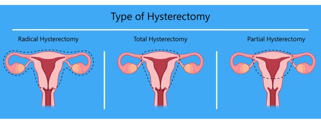 hysterectomy illustration types hysterectomy