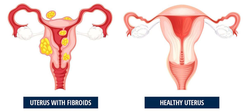 illustration subserosal uterine fibroids