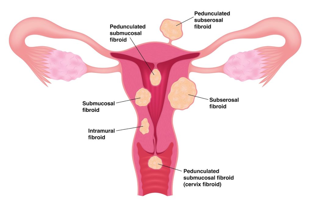 fibroid treatment types of uterine fibroids