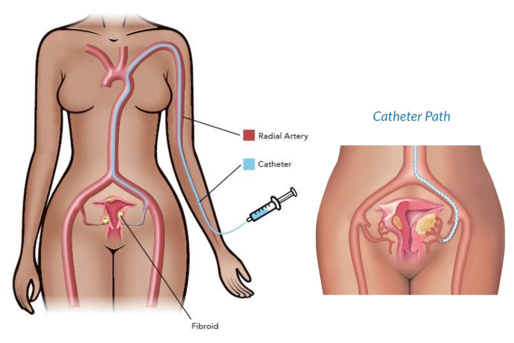 fibroid doctor illustration ufe full body