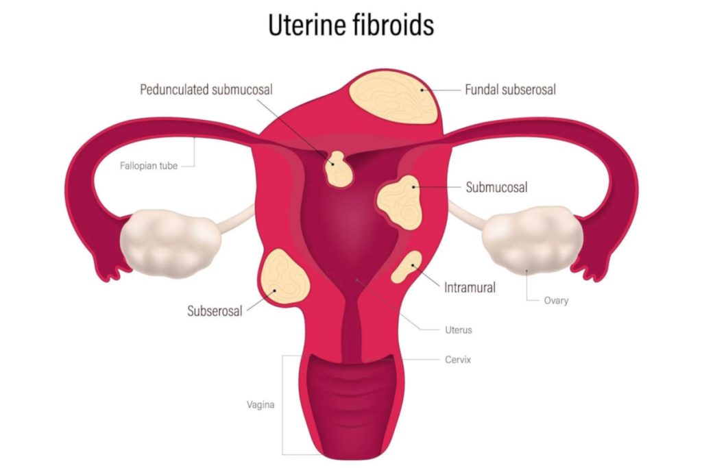 pedunculated fibroids illustration fibroid locations