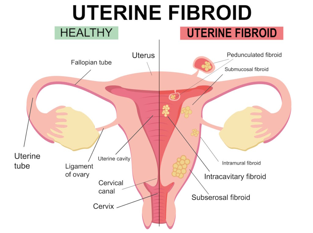 fibroid treatment illustration uterine fibroids