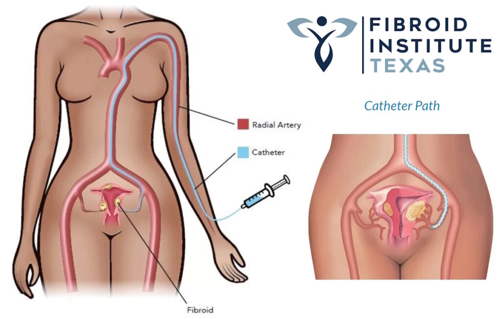best fibroid doctor illustration ufe full body fibroidfree.com