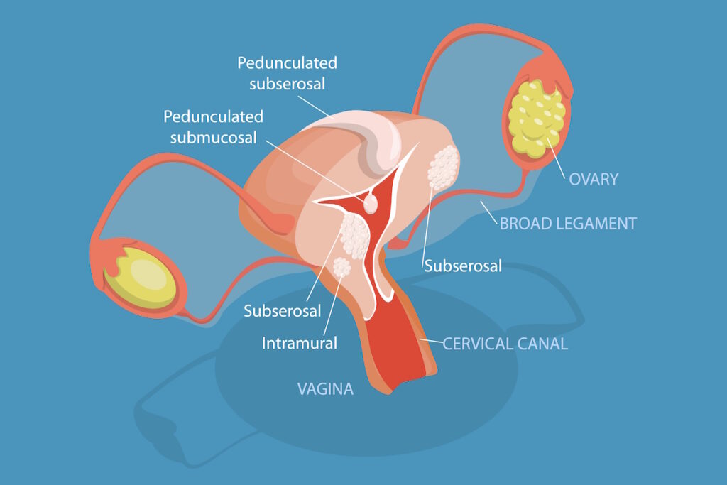 best fibroid doctor illustration fibroid types