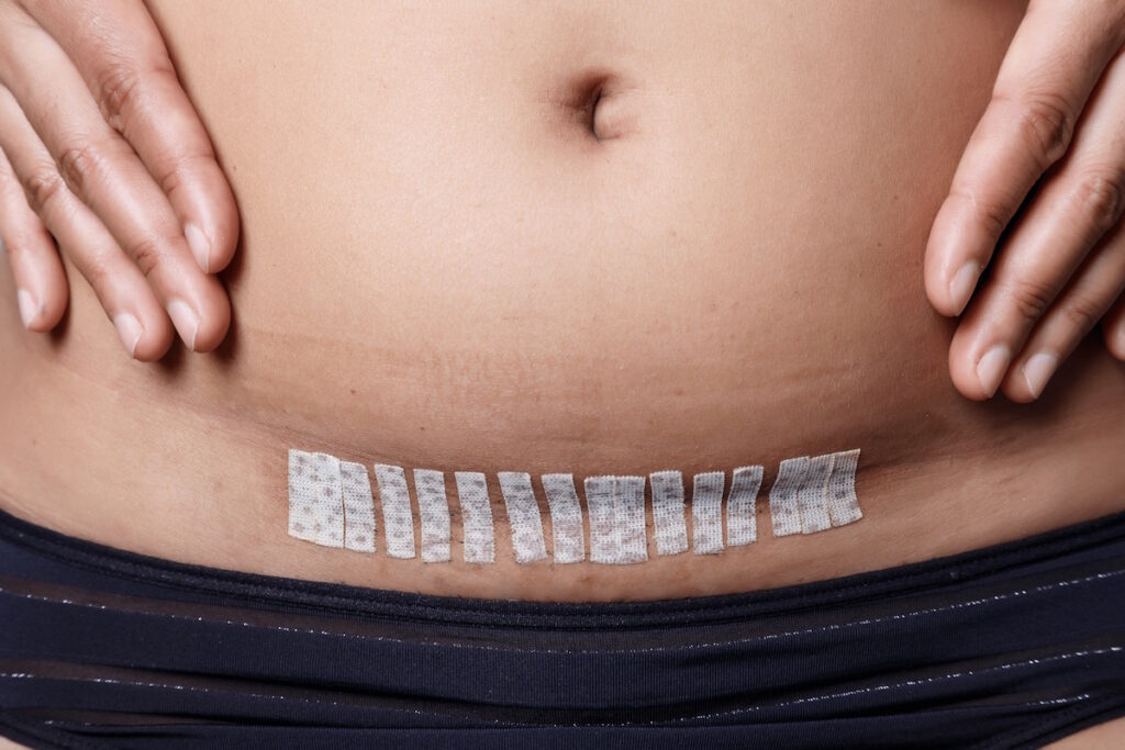 fibroid surgery scars hysterectomy scarring after incision