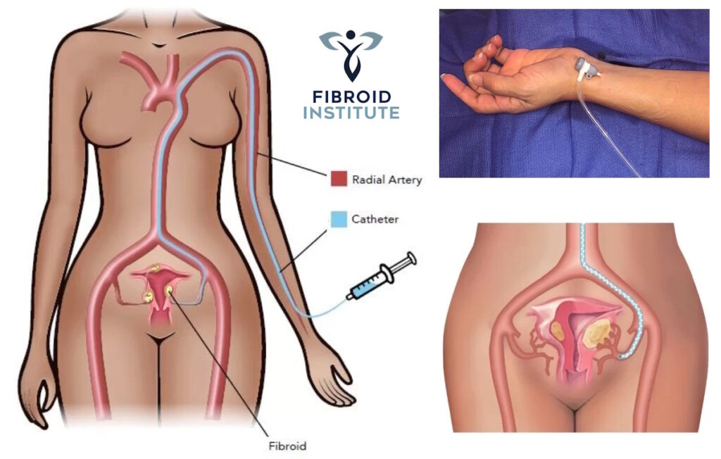 illustration ufe full body wrist detail fibroid doctors fibroid free com